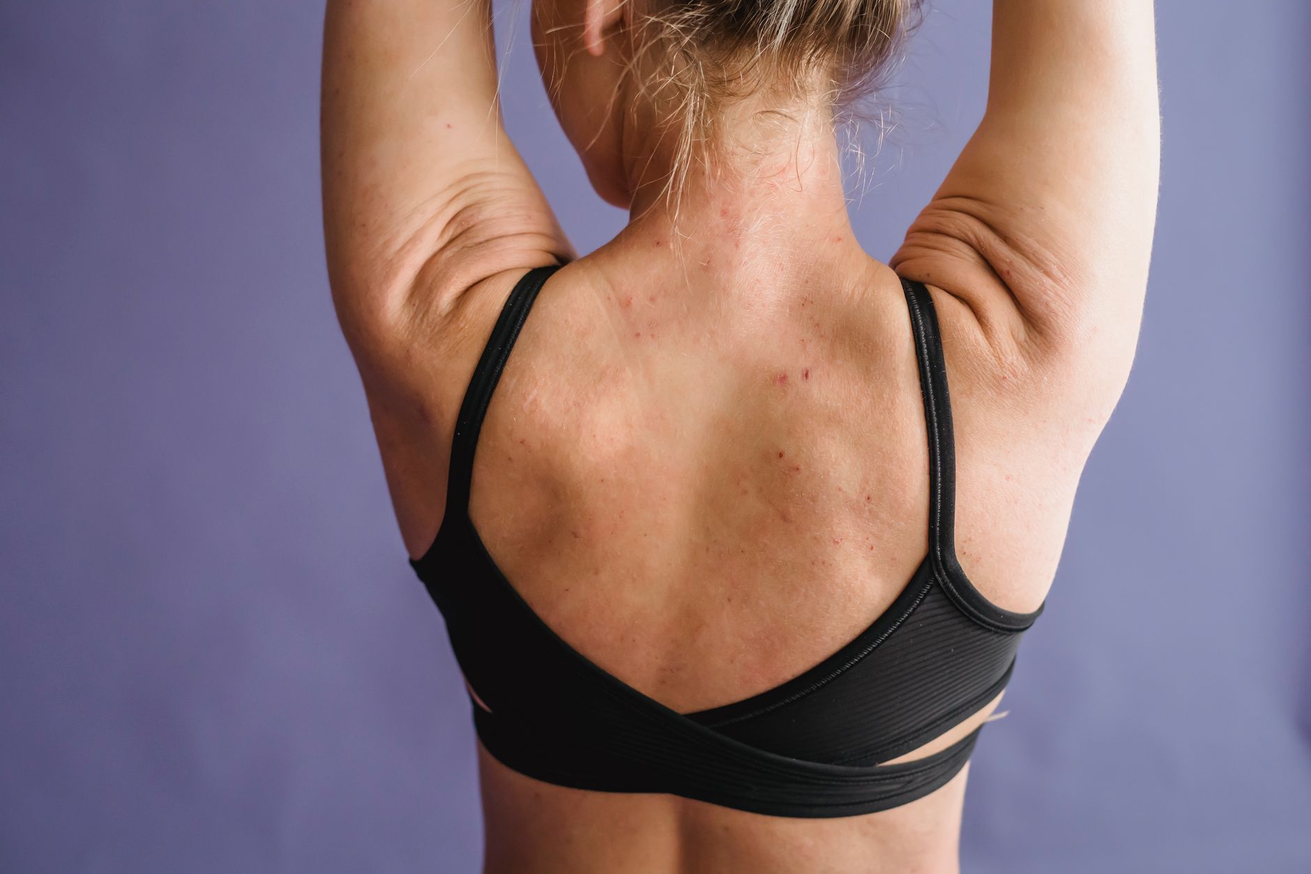 HIVES: raised welts on the skin